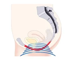 Pelvic Restoration HIFEM treatment illustration